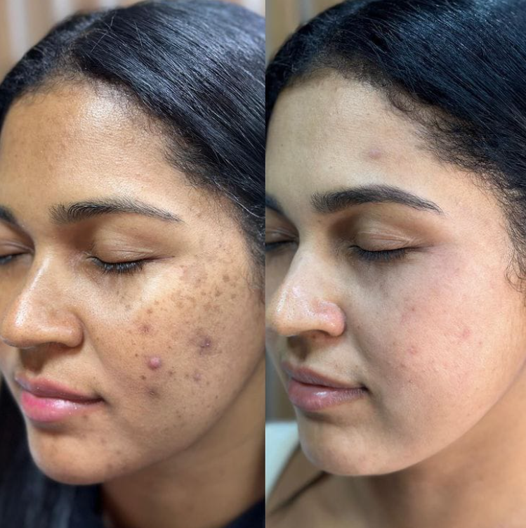 Acne & Pimple Treatment